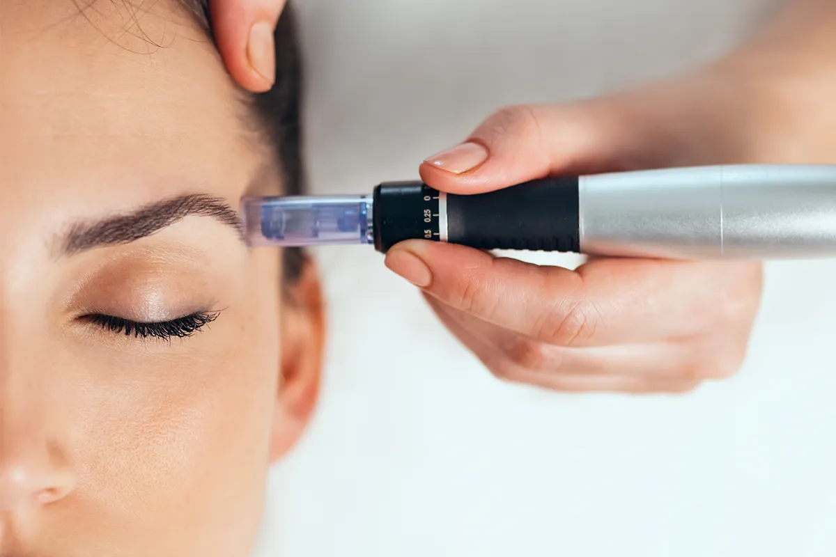 Microneedling an der Schläfe einer weiblichen Person