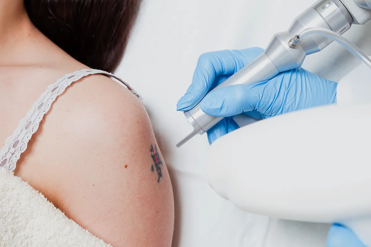 Tattooentfernung mit einem Handlaser an dem Oberarm einer weiblichen Person