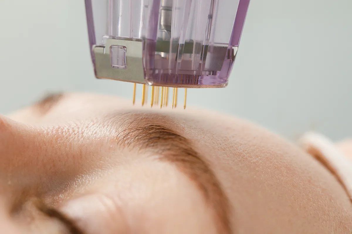 Microneedling schmerzfreie Hautverjüngung Nahaufnahme Microneedling nahe der Augenbraun