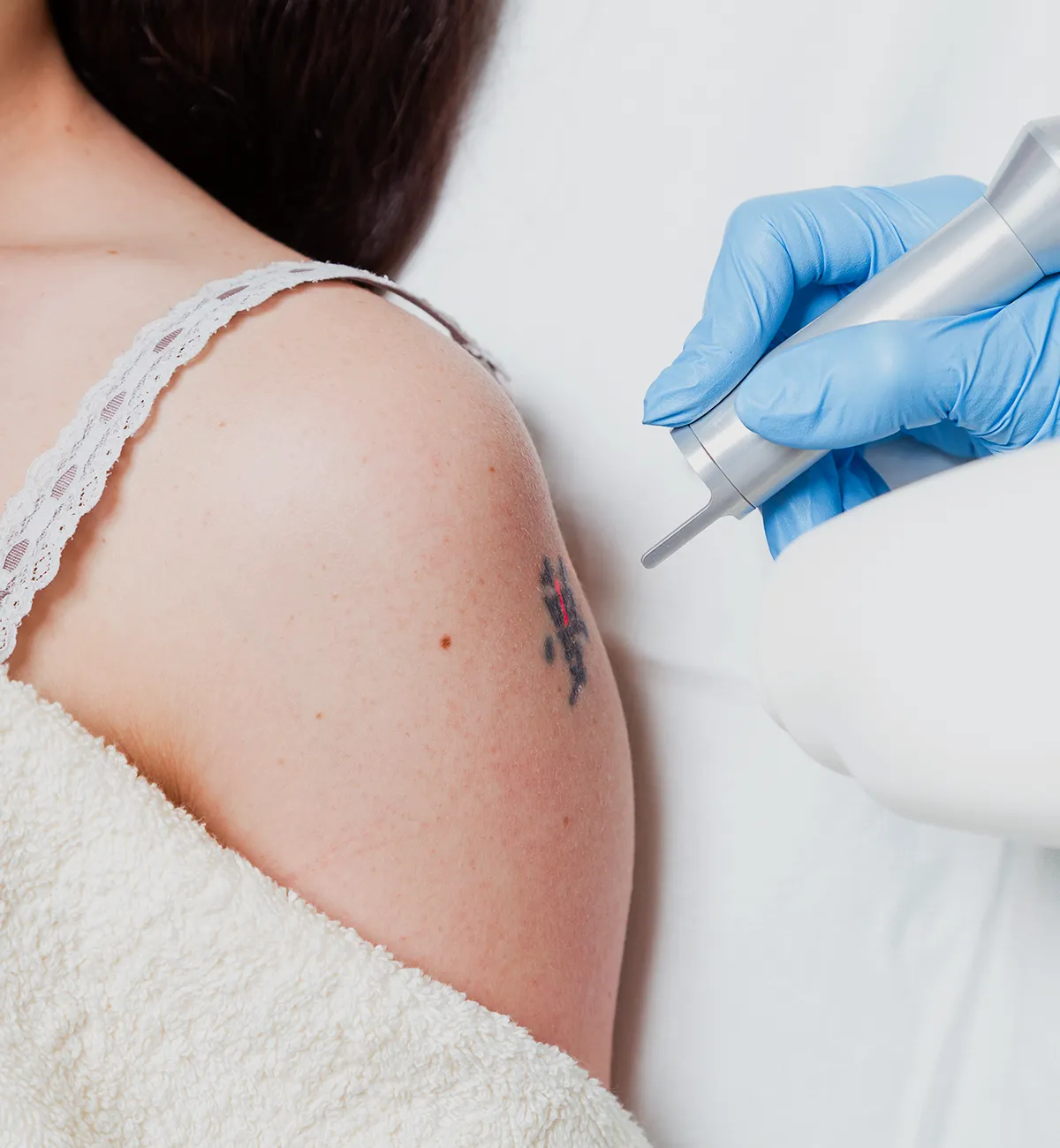 Tattooentfernung mit einem Handlaser an dem Oberarm einer weiblichen Person