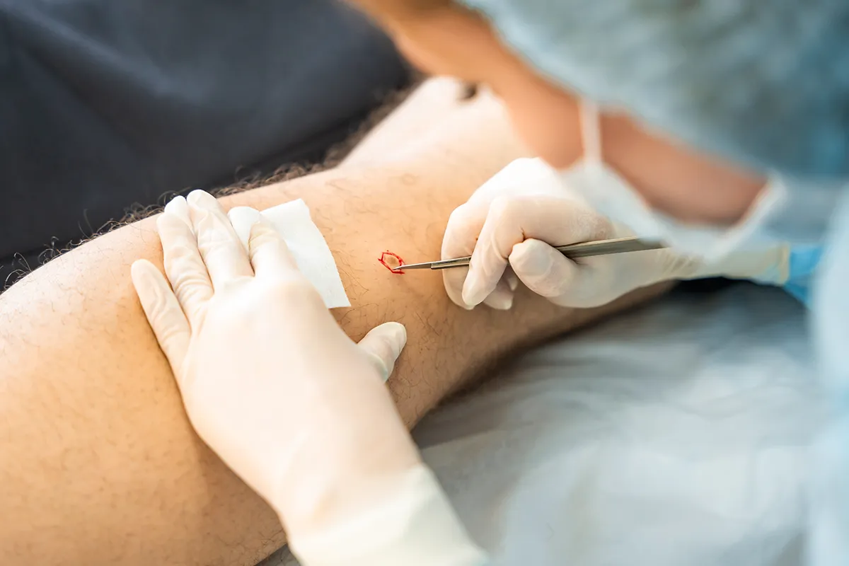 Muttermalentfernung durch medizinisches Personal an einem Unterarm