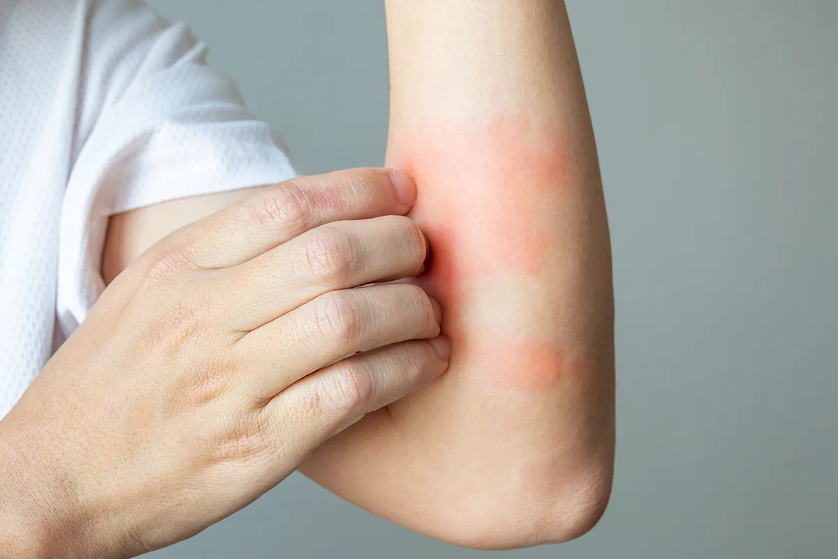 Ein linker rechte Ellebogenbeuge mit roten Ausschlag und die rechte Hand kratzt an der Stelle